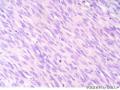 经典病例学习-高分化纤维肉瘤图15