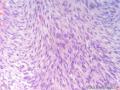经典病例学习-高分化纤维肉瘤图10