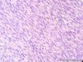 经典病例学习-高分化纤维肉瘤图13