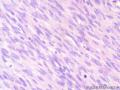 经典病例学习-高分化纤维肉瘤图16