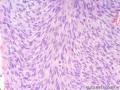 经典病例学习-高分化纤维肉瘤图9
