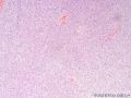 经典病例学习-高分化纤维肉瘤图4