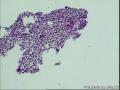 支气管活检，男性，58岁，CT：右肺门zhanwe图6