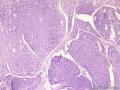 经典病例学习-腺样囊性癌图6