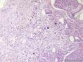 经典病例学习-腺样囊性癌图7