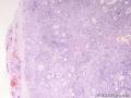经典病例学习-腺样囊性癌图1