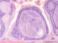经典病例学习-腺样囊性癌图19