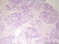 经典病例学习-腺样囊性癌图2
