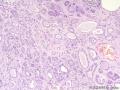 经典病例学习-腺样囊性癌图8
