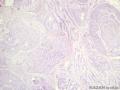 经典病例学习-腺样囊性癌图4