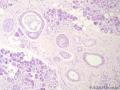 经典病例学习-腺样囊性癌图16