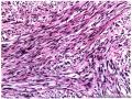 经典病例学习-高分化纤维肉瘤图18