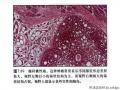 经典病例学习-腺样囊性癌图36