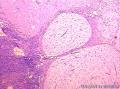 卵巢表面赘生物图4