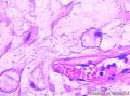 卵巢表面赘生物图12