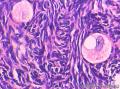 卵巢表面赘生物图17