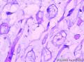 卵巢表面赘生物图11