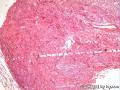 女，42子宫平滑肌瘤，核内有小的红核仁，有问题吗？图3