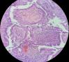 女，25岁 卵巢肿物------浆液性 OR 黏液性 肿瘤？图3