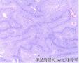 膀胱肿物 新加免疫组化图1