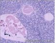 膀胱肿物 新加免疫组化图18