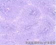 膀胱肿物 新加免疫组化图10