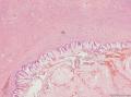 肾结石积水并腺癌---转移性OR原发？图4