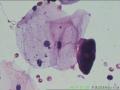 宫颈液基  又上传了图片急请会诊！图50