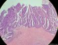 肾结石积水并腺癌---转移性OR原发？图9