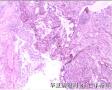 膀胱肿物图4