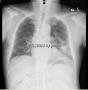 CT 引导下肺穿刺一例（含影像学及特染）图8
