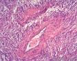 经典病例学习-肾血管平滑肌脂肪瘤图7