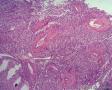 经典病例学习-肾血管平滑肌脂肪瘤图6