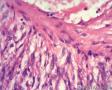 经典病例学习-肾血管平滑肌脂肪瘤图9