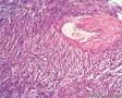 经典病例学习-肾血管平滑肌脂肪瘤图8