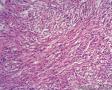 经典病例学习-肾血管平滑肌脂肪瘤图10