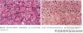 嫌色肾细胞癌与嗜酸细胞瘤图1