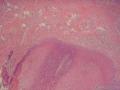 舌体肿物图18