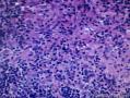 结节性淋巴细胞为主霍奇金淋巴瘤图9