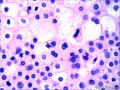 肾：嫌色性肾细胞癌图7