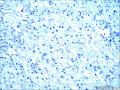 肾：嫌色性肾细胞癌图15