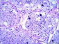 肾：嫌色性肾细胞癌图5