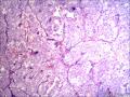 肾：嫌色性肾细胞癌图2
