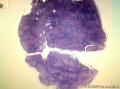 结节性淋巴细胞为主霍奇金淋巴瘤图1