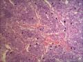 肾：嫌色性肾细胞癌图3