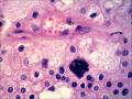 肾：嫌色性肾细胞癌图8
