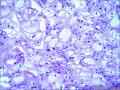 肾：嫌色性肾细胞癌图6