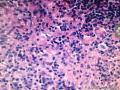 结节性淋巴细胞为主霍奇金淋巴瘤图6