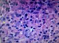 结节性淋巴细胞为主霍奇金淋巴瘤图10
