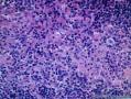结节性淋巴细胞为主霍奇金淋巴瘤图8